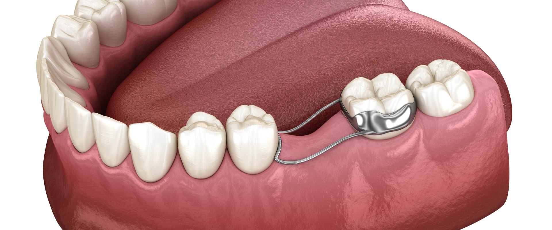 Building Beautiful Smiles: Essential Dentistry Tools For Dental Bridges In Round Rock, TX