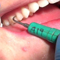 The Risks of Ultrasonic Scalers in Dentistry