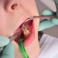 What Tools Do Dentists Use to Fill Cavities? A Comprehensive Guide