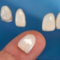 How Can Dentists Enhance Your Smile With Porcelain Veneers Using Advanced Dentistry Tools And Techniques In Cedar Park, TX