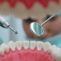 The Advantages of Electric Dental Drills in Dentistry