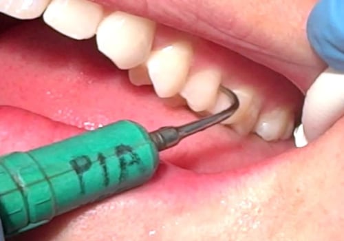 The Risks of Ultrasonic Scalers in Dentistry
