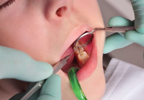 What Tools Do Dentists Use to Fill Cavities? A Comprehensive Guide