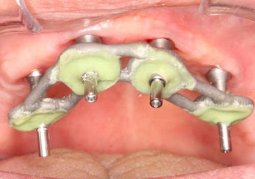 The Advantages and Disadvantages of Intraoral Cameras in Dentistry