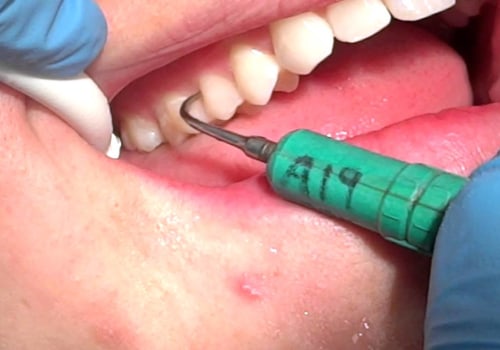 What is a Dental Scaler Tip Used For? - An Expert's Guide